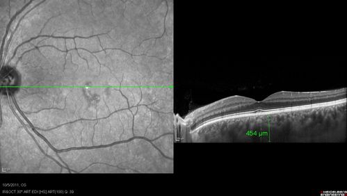 Acute Central Serous Retinopathy - CSR - Steroid Induced (probably) - Good Vision 
42-year-old man was seen in the office on October 5, 2011.  He had noticed starting in August after a course of antibiotic and steroids, that he developed new spots in his vision in the right eye.  He may have had an episode like this sometime in the past.  He did take steroids a few years ago and his vision did change at that time, but then returned.  

VISUAL ACUITY:  OD 20/32,  OS 20/32.  The OCT scan of the right eye confirms subretinal fluid.
