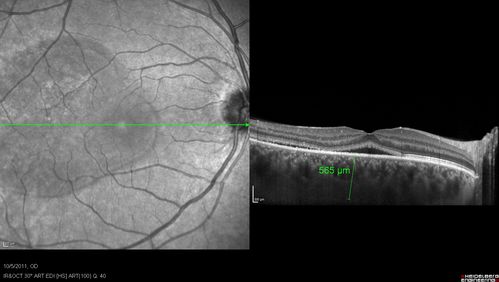 Acute Central Serous Retinopathy - CSR - Steroid Induced (probably) - Good Vision 
42-year-old man was seen in the office on October 5, 2011.  He had noticed starting in August after a course of antibiotic and steroids, that he developed new spots in his vision in the right eye.  He may have had an episode like this sometime in the past.  He did take steroids a few years ago and his vision did change at that time, but then returned.  

VISUAL ACUITY:  OD 20/32,  OS 20/32.  The OCT scan of the right eye confirms subretinal fluid.
