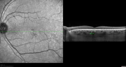 Acute Central Serous Retinopathy - CSR - Steroid Induced (probably) - Good Vision 
42-year-old man was seen in the office on October 5, 2011.  He had noticed starting in August after a course of antibiotic and steroids, that he developed new spots in his vision in the right eye.  He may have had an episode like this sometime in the past.  He did take steroids a few years ago and his vision did change at that time, but then returned.  

VISUAL ACUITY:  OD 20/32,  OS 20/32.  The OCT scan of the right eye confirms subretinal fluid.
