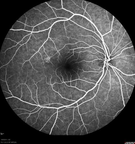 Acute Central Serous Retinopathy - CSR - Steroid Induced (probably) - Good Vision  - FA Affected Eye
42-year-old man was seen in the office on October 5, 2011.  He had noticed starting in August after a course of antibiotic and steroids, that he developed new spots in his vision in the right eye.  He may have had an episode like this sometime in the past.  He did take steroids a few years ago and his vision did change at that time, but then returned.  

VISUAL ACUITY:  OD 20/32,  OS 20/32.  The OCT scan of the right eye confirms subretinal fluid.
