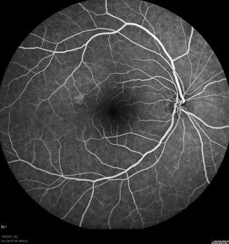 Acute Central Serous Retinopathy - CSR - Steroid Induced (probably) - Good Vision  - FA Affected Eye
42-year-old man was seen in the office on October 5, 2011.  He had noticed starting in August after a course of antibiotic and steroids, that he developed new spots in his vision in the right eye.  He may have had an episode like this sometime in the past.  He did take steroids a few years ago and his vision did change at that time, but then returned.  

VISUAL ACUITY:  OD 20/32,  OS 20/32.  The OCT scan of the right eye confirms subretinal fluid.
