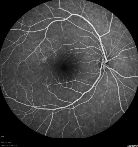 Acute Central Serous Retinopathy - CSR - Steroid Induced (probably) - Good Vision - FA Affected Eye
42-year-old man was seen in the office on October 5, 2011.  He had noticed starting in August after a course of antibiotic and steroids, that he developed new spots in his vision in the right eye.  He may have had an episode like this sometime in the past.  He did take steroids a few years ago and his vision did change at that time, but then returned.  

VISUAL ACUITY:  OD 20/32,  OS 20/32.  The OCT scan of the right eye confirms subretinal fluid.
