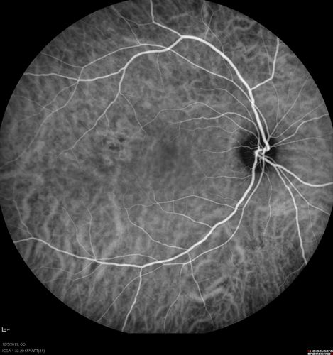 Acute Central Serous Retinopathy - CSR - Steroid Induced (probably) - Good Vision - ICG Affected Eye - Choroidal Leakage
42-year-old man was seen in the office on October 5, 2011.  He had noticed starting in August after a course of antibiotic and steroids, that he developed new spots in his vision in the right eye.  He may have had an episode like this sometime in the past.  He did take steroids a few years ago and his vision did change at that time, but then returned.  

VISUAL ACUITY:  OD 20/32,  OS 20/32.  The OCT scan of the right eye confirms subretinal fluid.
