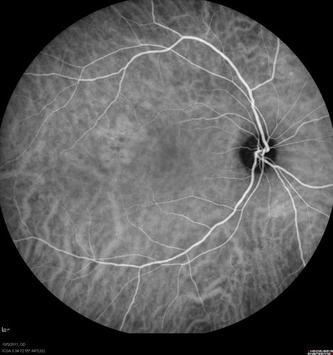 Acute Central Serous Retinopathy - CSR - Steroid Induced (probably) - Good Vision - ICG Affected Eye - Choroidal Leakage
42-year-old man was seen in the office on October 5, 2011.  He had noticed starting in August after a course of antibiotic and steroids, that he developed new spots in his vision in the right eye.  He may have had an episode like this sometime in the past.  He did take steroids a few years ago and his vision did change at that time, but then returned.  

VISUAL ACUITY:  OD 20/32,  OS 20/32.  The OCT scan of the right eye confirms subretinal fluid.
