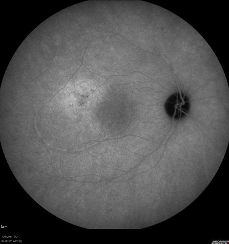 Acute Central Serous Retinopathy - CSR - Steroid Induced (probably) - Good Vision - ICG Affected Eye - Choroidal Leakage
42-year-old man was seen in the office on October 5, 2011.  He had noticed starting in August after a course of antibiotic and steroids, that he developed new spots in his vision in the right eye.  He may have had an episode like this sometime in the past.  He did take steroids a few years ago and his vision did change at that time, but then returned.  

VISUAL ACUITY:  OD 20/32,  OS 20/32.  The OCT scan of the right eye confirms subretinal fluid.
