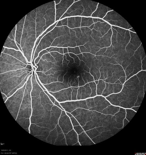 Acute Central Serous Retinopathy - CSR - Steroid Induced (probably) - Good Vision  - FA Fellow Eye
42-year-old man was seen in the office on October 5, 2011.  He had noticed starting in August after a course of antibiotic and steroids, that he developed new spots in his vision in the right eye.  He may have had an episode like this sometime in the past.  He did take steroids a few years ago and his vision did change at that time, but then returned.  

VISUAL ACUITY:  OD 20/32,  OS 20/32.  The OCT scan of the right eye confirms subretinal fluid.

