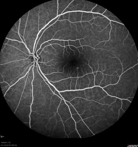 Acute Central Serous Retinopathy - CSR - Steroid Induced (probably) - Good Vision  - FA Fellow Eye
42-year-old man was seen in the office on October 5, 2011.  He had noticed starting in August after a course of antibiotic and steroids, that he developed new spots in his vision in the right eye.  He may have had an episode like this sometime in the past.  He did take steroids a few years ago and his vision did change at that time, but then returned.  

VISUAL ACUITY:  OD 20/32,  OS 20/32.  The OCT scan of the right eye confirms subretinal fluid.

