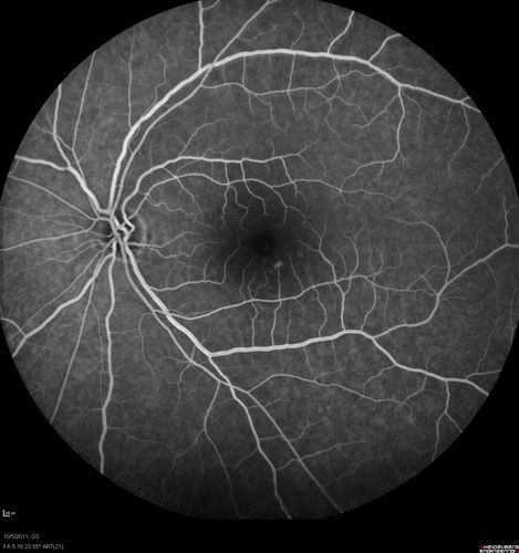 Acute Central Serous Retinopathy - CSR - Steroid Induced (probably) - Good Vision - FA Fellow Eye
42-year-old man was seen in the office on October 5, 2011.  He had noticed starting in August after a course of antibiotic and steroids, that he developed new spots in his vision in the right eye.  He may have had an episode like this sometime in the past.  He did take steroids a few years ago and his vision did change at that time, but then returned.  

VISUAL ACUITY:  OD 20/32,  OS 20/32.  The OCT scan of the right eye confirms subretinal fluid.
