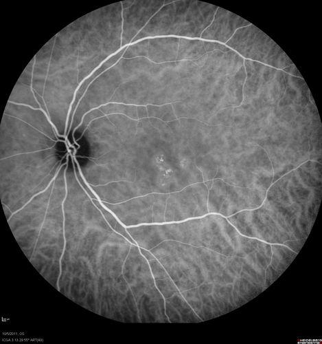 Acute Central Serous Retinopathy - CSR - Steroid Induced (probably) - Good Vision - ICG Fellow Eye
42-year-old man was seen in the office on October 5, 2011.  He had noticed starting in August after a course of antibiotic and steroids, that he developed new spots in his vision in the right eye.  He may have had an episode like this sometime in the past.  He did take steroids a few years ago and his vision did change at that time, but then returned.  

VISUAL ACUITY:  OD 20/32,  OS 20/32.  The OCT scan of the right eye confirms subretinal fluid.
