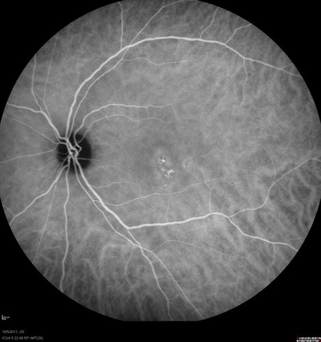 Acute Central Serous Retinopathy - CSR - Steroid Induced (probably) - Good Vision - ICG Fellow Eye
42-year-old man was seen in the office on October 5, 2011.  He had noticed starting in August after a course of antibiotic and steroids, that he developed new spots in his vision in the right eye.  He may have had an episode like this sometime in the past.  He did take steroids a few years ago and his vision did change at that time, but then returned.  

VISUAL ACUITY:  OD 20/32,  OS 20/32.  The OCT scan of the right eye confirms subretinal fluid.
