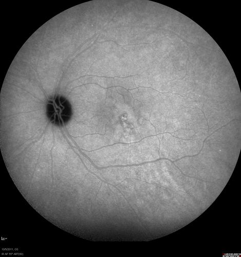 Acute Central Serous Retinopathy - CSR - Steroid Induced (probably) - Good Vision - ICG Fellow Eye
42-year-old man was seen in the office on October 5, 2011.  He had noticed starting in August after a course of antibiotic and steroids, that he developed new spots in his vision in the right eye.  He may have had an episode like this sometime in the past.  He did take steroids a few years ago and his vision did change at that time, but then returned.  

VISUAL ACUITY:  OD 20/32,  OS 20/32.  The OCT scan of the right eye confirms subretinal fluid.
