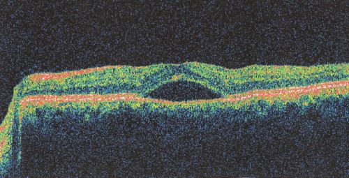 Central Serous Retinopathy
OCT scan showing serous RD
Keywords: Central Serous Retinopathy