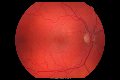 Acute Central Serous Chorioretinopathy with Symptoms in Hazy Vision Both Eyes
48-year-old man with hazy vision in the right eye for about three days.  He has a little more of a headache than usual.  He is under a fair amount of stress.  He does not take any steroids that he knows of.  He does use a nasal spray, which he is not sure if that is a steroid spray or not.  He is going to call us with that medicine.  I checked his blood pressure today is was 115/95.   

VISUAL ACUITY:  OD 20/15, OS 20/25
