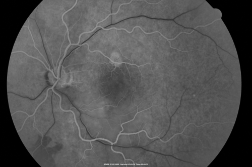 Acute Central Serous Chorioretinopathy with Symptoms in Hazy Vision Both Eyes
48-year-old man with hazy vision in the right eye for about three days.  He has a little more of a headache than usual.  He is under a fair amount of stress.  He does not take any steroids that he knows of.  He does use a nasal spray, which he is not sure if that is a steroid spray or not.  He is going to call us with that medicine.  I checked his blood pressure today is was 115/95.   

VISUAL ACUITY:  OD 20/15, OS 20/25
