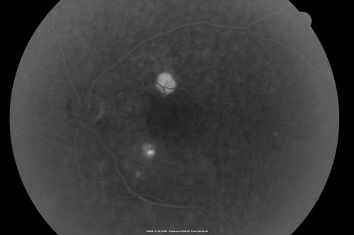 Acute Central Serous Chorioretinopathy with Symptoms in Hazy Vision Both Eyes
48-year-old man with hazy vision in the right eye for about three days.  He has a little more of a headache than usual.  He is under a fair amount of stress.  He does not take any steroids that he knows of.  He does use a nasal spray, which he is not sure if that is a steroid spray or not.  He is going to call us with that medicine.  I checked his blood pressure today is was 115/95.   

VISUAL ACUITY:  OD 20/15, OS 20/25
