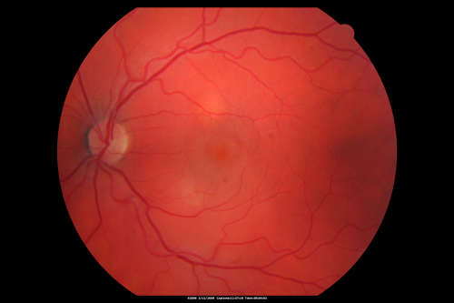 Acute Central Serous Chorioretinopathy with Symptoms in Hazy Vision Both Eyes
48-year-old man with hazy vision in the right eye for about three days.  He has a little more of a headache than usual.  He is under a fair amount of stress.  He does not take any steroids that he knows of.  He does use a nasal spray, which he is not sure if that is a steroid spray or not.  He is going to call us with that medicine.  I checked his blood pressure today is was 115/95.   

VISUAL ACUITY:  OD 20/15, OS 20/25
