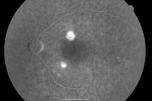 Acute Central Serous Chorioretinopathy with Symptoms in Hazy Vision Both Eyes
48-year-old man with hazy vision in the right eye for about three days.  He has a little more of a headache than usual.  He is under a fair amount of stress.  He does not take any steroids that he knows of.  He does use a nasal spray, which he is not sure if that is a steroid spray or not.  He is going to call us with that medicine.  I checked his blood pressure today is was 115/95.   

VISUAL ACUITY:  OD 20/15, OS 20/25
