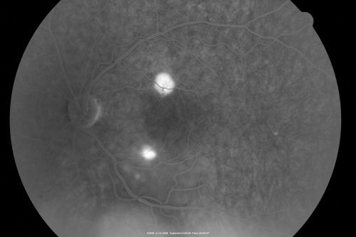 Acute Central Serous Chorioretinopathy with Symptoms in Hazy Vision Both Eyes
48-year-old man with hazy vision in the right eye for about three days.  He has a little more of a headache than usual.  He is under a fair amount of stress.  He does not take any steroids that he knows of.  He does use a nasal spray, which he is not sure if that is a steroid spray or not.  He is going to call us with that medicine.  I checked his blood pressure today is was 115/95.   

VISUAL ACUITY:  OD 20/15, OS 20/25
