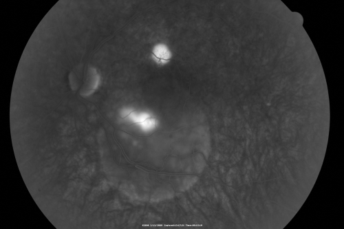 Acute Central Serous Chorioretinopathy with Symptoms in Hazy Vision Both Eyes
48-year-old man with hazy vision in the right eye for about three days.  He has a little more of a headache than usual.  He is under a fair amount of stress.  He does not take any steroids that he knows of.  He does use a nasal spray, which he is not sure if that is a steroid spray or not.  He is going to call us with that medicine.  I checked his blood pressure today is was 115/95.   

VISUAL ACUITY:  OD 20/15, OS 20/25

