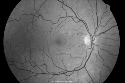 Acute Central Serous Chorioretinopathy with Symptoms in Hazy Vision Both Eyes
