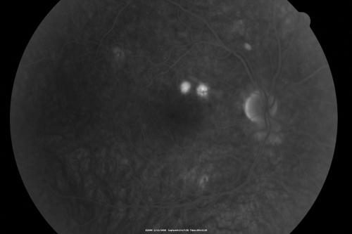 Acute Central Serous Chorioretinopathy with Symptoms in Hazy Vision Both Eyes
48-year-old man with hazy vision in the right eye for about three days.  He has a little more of a headache than usual.  He is under a fair amount of stress.  He does not take any steroids that he knows of.  He does use a nasal spray, which he is not sure if that is a steroid spray or not.  He is going to call us with that medicine.  I checked his blood pressure today is was 115/95.   

VISUAL ACUITY:  OD 20/15, OS 20/25
