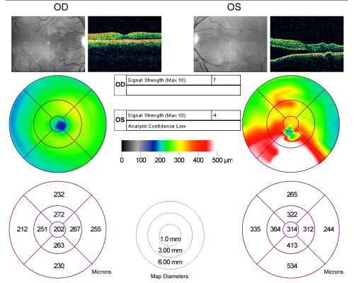 Acute Central Serous Chorioretinopathy with Symptoms in Hazy Vision Both Eyes
