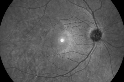 Acute Central Serous Retinopathy - CSR - Steroid Induced (probably) - Good Vision - 6 months later - vision Better INFRARED SHOWS EXACT VISION DEFECT
42-year-old man has central serous retinopathy in the right eye with serous retinal detachment. 6 month follow-up Vision is better.OD 20/20. The patient looked at this infra-red image and said "That's exactly what I see!"
