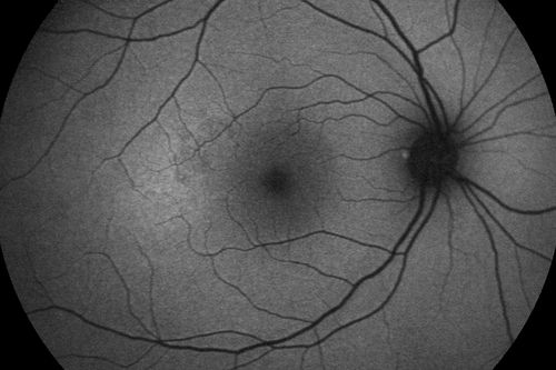 Acute Central Serous Retinopathy - CSR - Steroid Induced (probably) - Good Vision - 6 months later - vision Better - FAF shows small abnormality
42-year-old man has central serous retinopathy in the right eye with serous retinal detachment. 6 month follow-up Vision is better.

VISUAL ACUITY:  OD 20/20. 
