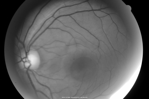 Central Serous Retinopathy
Red Free photo
Schlüsselwörter: Central Serous Retinopathy
