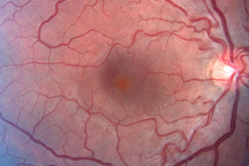 Acute Central Serous Retinopathy - Classic Smokestack on Fluorescein Angiogram 
34-year-old man noticed about five days ago decreased vision in the right eye.  He was having difficulty playing video games and seeing with that eye.  He thought maybe his refractive error was shifting.  
VISUAL ACUITY:  Vision OD is 20/40, OS is 20/16
