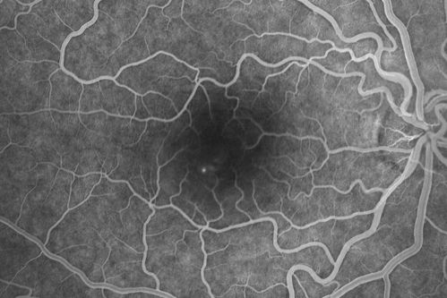 Acute Central Serous Retinopathy - Classic Smokestack on Fluorescein Angiogram 
34-year-old man noticed about five days ago decreased vision in the right eye.  He was having difficulty playing video games and seeing with that eye.  He thought maybe his refractive error was shifting.  
VISUAL ACUITY:  Vision OD is 20/40, OS is 20/16
