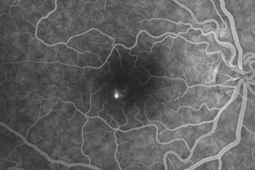 Acute Central Serous Retinopathy - Classic Smokestack on Fluorescein Angiogram 
34-year-old man noticed about five days ago decreased vision in the right eye.  He was having difficulty playing video games and seeing with that eye.  He thought maybe his refractive error was shifting.  
VISUAL ACUITY:  Vision OD is 20/40, OS is 20/16

