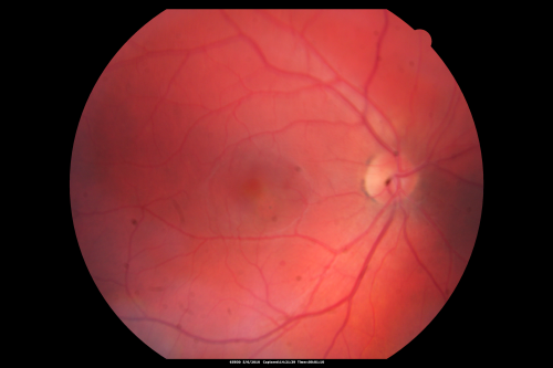 Central Serous Retinopathy - Steroid Induced - Serous Retinal Detachment
38-year-old man has noticed a spot in the right eye.  The vision was a little bit off for a few weeks and then just recently he noticed that it was the right eye.  He did take high dose oral steroids for about two weeks in early March and he was using an intermittent steroid inhaler, but he has not used anything recently.  He is under a lot of stress.  

VISUAL ACUITY:  OD 20/100,  OS 20/50.
