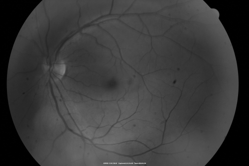 Central Serous Retinopathy - Steroid Induced - Serous Retinal Detachment
38-year-old man has noticed a spot in the right eye.  The vision was a little bit off for a few weeks and then just recently he noticed that it was the right eye.  He did take high dose oral steroids for about two weeks in early March and he was using an intermittent steroid inhaler, but he has not used anything recently.  He is under a lot of stress.  

VISUAL ACUITY:  OD 20/100,  OS 20/50.
