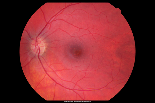 Cuticular Drusen - 26 year old female - Glomerulonephritis
VA 20/25 OU.  Images are over 4 years
