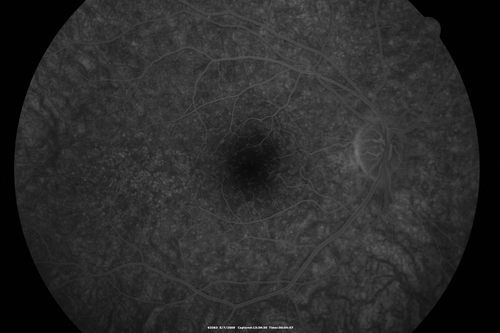 Cuticular Drusen - 26 year old female - Glomerulonephritis
VA 20/25 OU.  Images are over 4 years.  FA shows starry sky early images - This is because of loss of RPE over the drusen creating very small window defects.
