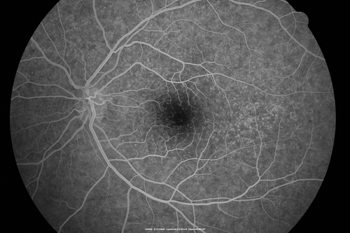 Cuticular Drusen - 26 year old female - Glomerulonephritis
VA 20/25 OU.  Images are over 4 years. FA shows starry sky early images - This is because of loss of RPE over the drusen creating very small window defects.
