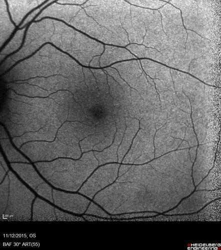Cuticular Drusen - 26 year old female - Glomerulonephritis
VA 20/25 OU.  Images are over 4 years
