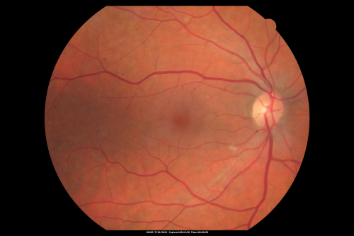 Cotton Wool Spots Both Eyes after Strep Pneumonia and Cardiac ICU Stay 1 Month Ago 
60-year-old man was sick in the hospital in 1 month ago with streptococcal pneumonia.  He was in the cardiac intensive care unit and at one point he was in critical condition. He has no visual complaints. OD 20/20,  OS 20/25.
