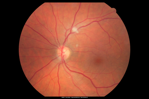 Cotton Wool Spots Both Eyes after Strep Pneumonia and Cardiac ICU Stay 1 Month Ago 
60-year-old man was sick in the hospital in 1 month ago with streptococcal pneumonia.  He was in the cardiac intensive care unit and at one point he was in critical condition. He has no visual complaints. OD 20/20,  OS 20/25.
