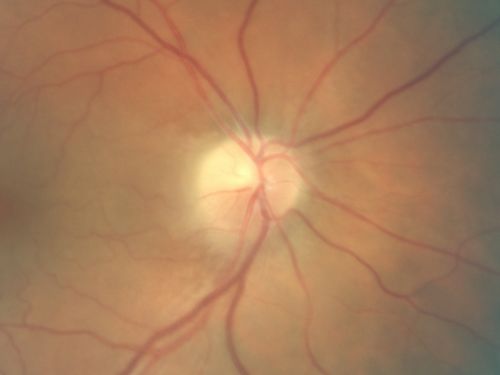 Non-Arteritic Anterior Ischemic Optic Neuropathy - Peripapillary Choroidal Ischemia
68-year-old woman noticed central vision loss in the right eye about a week ago.  It is getting a little bit better.   OD 20/160, OS 20/25.
