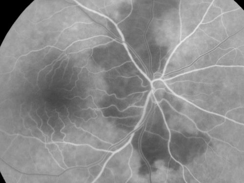Non-Arteritic Anterior Ischemic Optic Neuropathy - Peripapillary Choroidal Ischemia
68-year-old woman noticed central vision loss in the right eye about a week ago.  It is getting a little bit better.   OD 20/160, OS 20/25.
