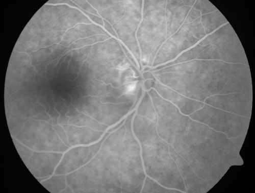 Non-Arteritic Anterior Ischemic Optic Neuropathy - Peripapillary Choroidal Ischemia
68-year-old woman noticed central vision loss in the right eye about a week ago.  It is getting a little bit better.   OD 20/160, OS 20/25.

