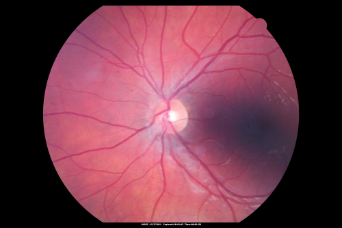 Perforating Steel Tip Dart Injury - 18 Months Post Injury - no vitrectomy - 20/40 Vision 
16-year-old had a dart injury to the left eye 18 months post injury. No vitrectomy. VISUAL ACUITY:  OS: Without correction 20/40
