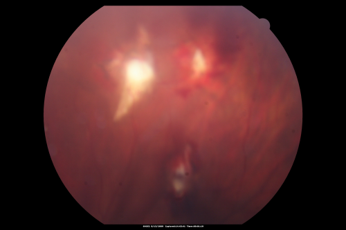 Steel Dart Perforating Injury - 15 year old - 3 weeks post-injury Vision 20/400
15-year-old injured in his left eye with a steel dart.    The dart entered superiorly at the pars plana and his vision is clearing as the blood absorbs.  

VISUAL ACUITY:  OD 20/20,  OS 20/400.
Keywords: vitreous hemorrhage; choroidal rupture