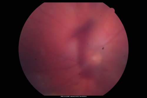 Steel Dart Perforating Injury - 15 year old - 3 weeks post-injury Vision 20/400
15-year-old injured in his left eye with a steel dart.    The dart entered superiorly at the pars plana and his vision is clearing as the blood absorbs.  

VISUAL ACUITY:  OD 20/20,  OS 20/400.
Keywords: vitreous hemorrhage; choroidal rupture