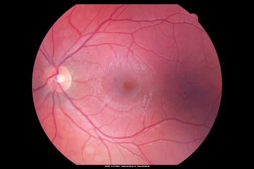 Perforating Steel Tip Dart Injury - 18 Months Post Injury - no vitrectomy - 20/40 Vision 
16-year-old had a dart injury to the left eye 18 months post injury. No vitrectomy. VISUAL ACUITY:  OS: Without correction 20/40
