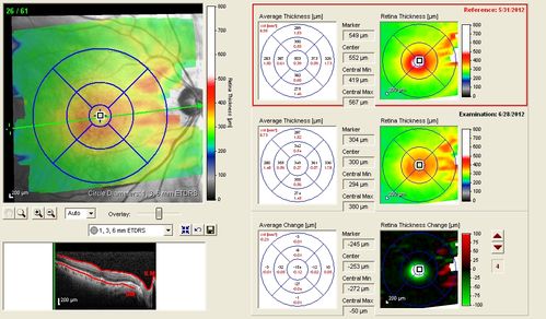 Lumigan (Bimatoprost) Cystoid Macular Edema - Eye Better 1 month after Stopping Lumigan
Vision back to 20/20 1 month after stopping Lumigan
