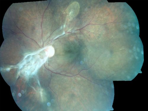 Preretinal Fibrosis - Tractional Retinal Detachment - Proliferative Diabetic Retinopathy 
33-year-old woman has proliferative diabetic retinopathy in the left eye with fibrosis and tractional retinal detachment.  Her vision is hazy in that eye.  VISUAL ACUITY:  Vision OD is 20/30, OS 20/120
