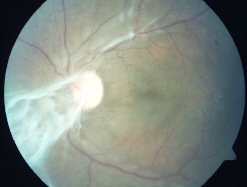 Preretinal Fibrosis - Tractional Retinal Detachment - Proliferative Diabetic Retinopathy 
33-year-old woman has proliferative diabetic retinopathy in the left eye with fibrosis and tractional retinal detachment.  Her vision is hazy in that eye.  VISUAL ACUITY:  Vision OD is 20/30, OS 20/120

